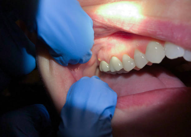 Best Emergency Root Canal Treatment in Harpersville, AL