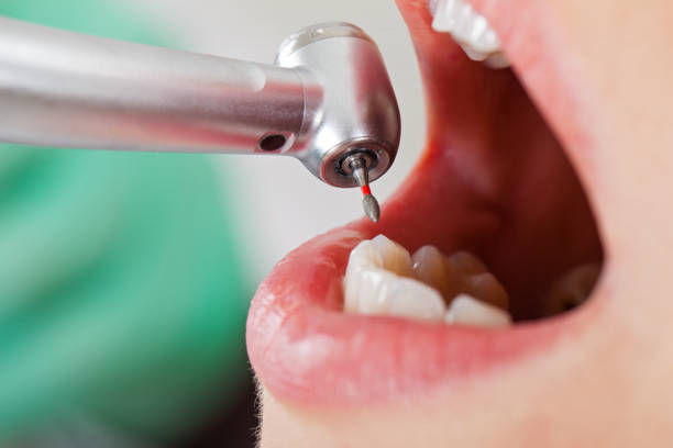 Best Emergency Tooth Extraction in Harpersville, AL